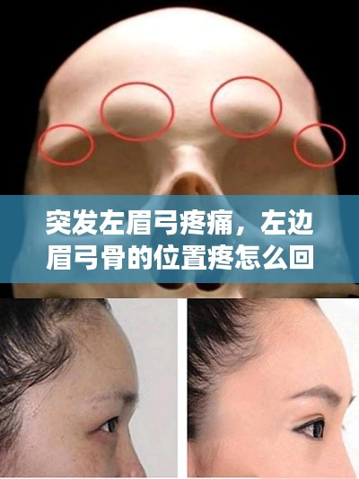 突发左眉弓疼痛,左边眉弓骨的位置疼怎么回事